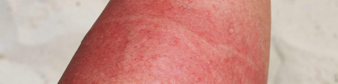 Picadura de medusa: síntomas, causas y prevención