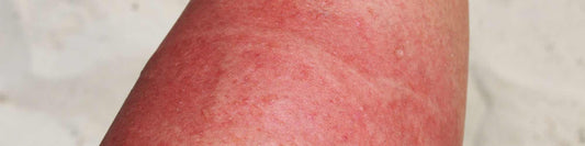 Quallenstich: Symptome, Ursachen und Prävention