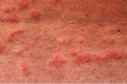 Was ist zu tun, wenn man von einer Qualle gestochen wird?